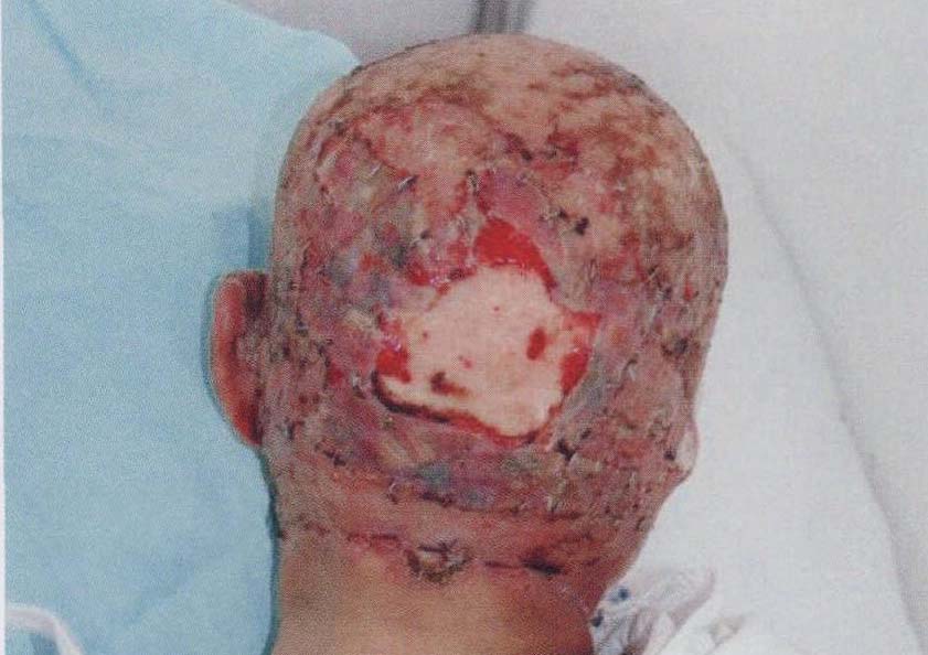 头部皮瓣手术成功图片图片